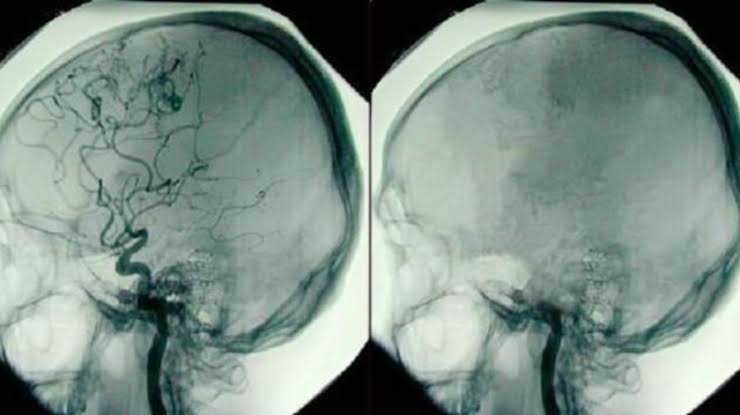 Muerte cerebral y muerte personal